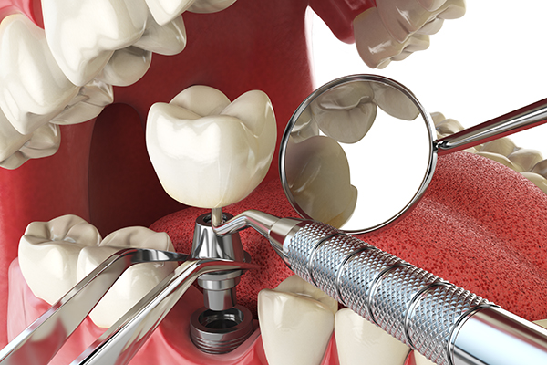 Dental Implants in Wellington FL