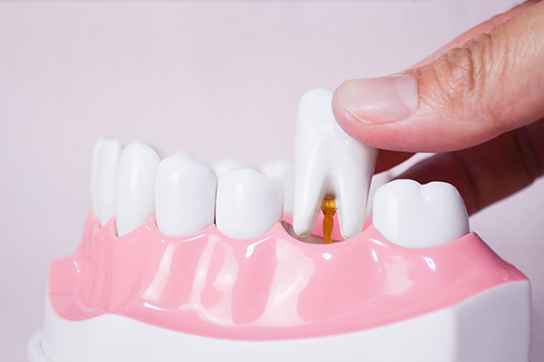 Wisdom Tooth Extractions Wellington FL